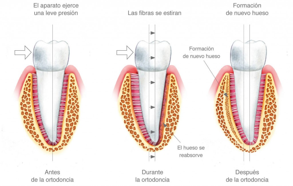 explica el movimiento lento de los dientes durante el tratamiento de ortodoncia y la contínua eliminación y creación de hueso alrededor de ellos durante el proceso